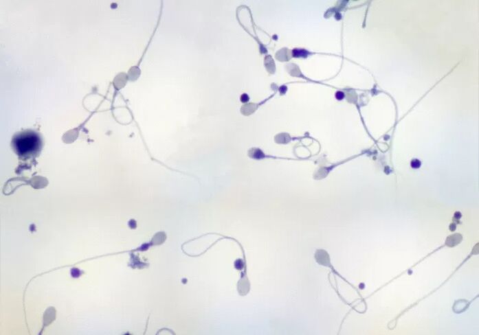 Diagnosis of oligozoospermia - few sperm